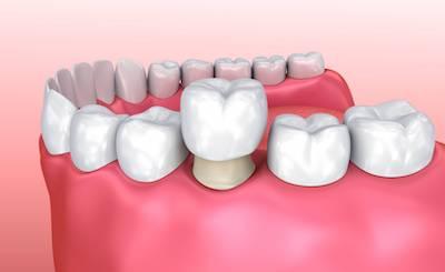 dental crown illustration in vienna va