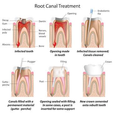 Root canal illustration