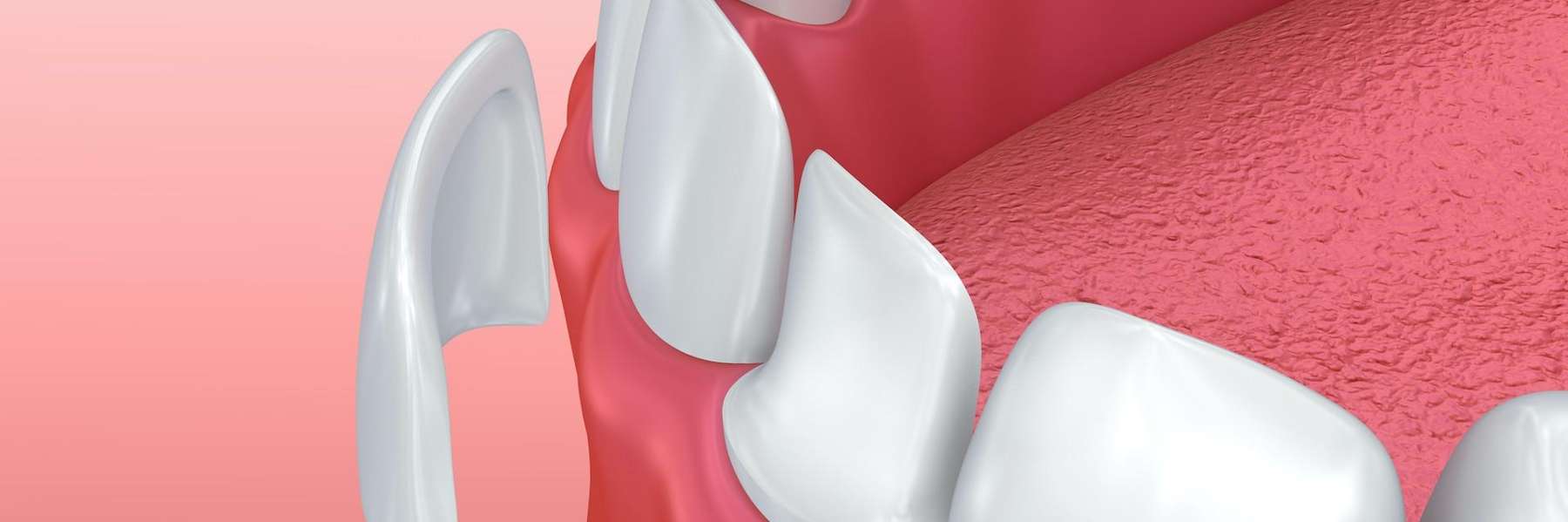 veneers illustration in vienna va