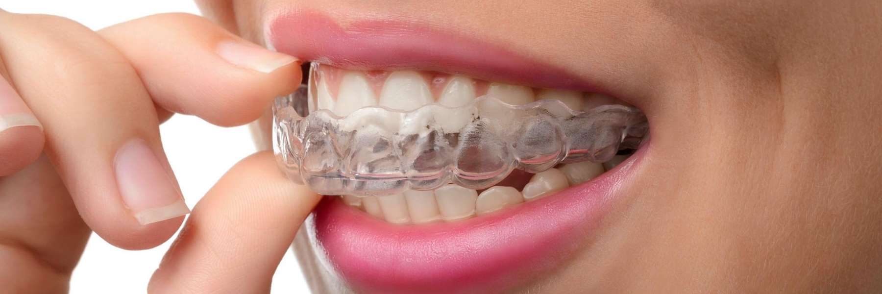 Invisalign inside the mouth