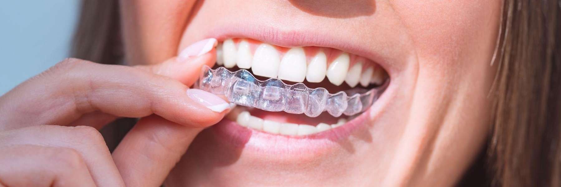 Factors to Consider Invisalign