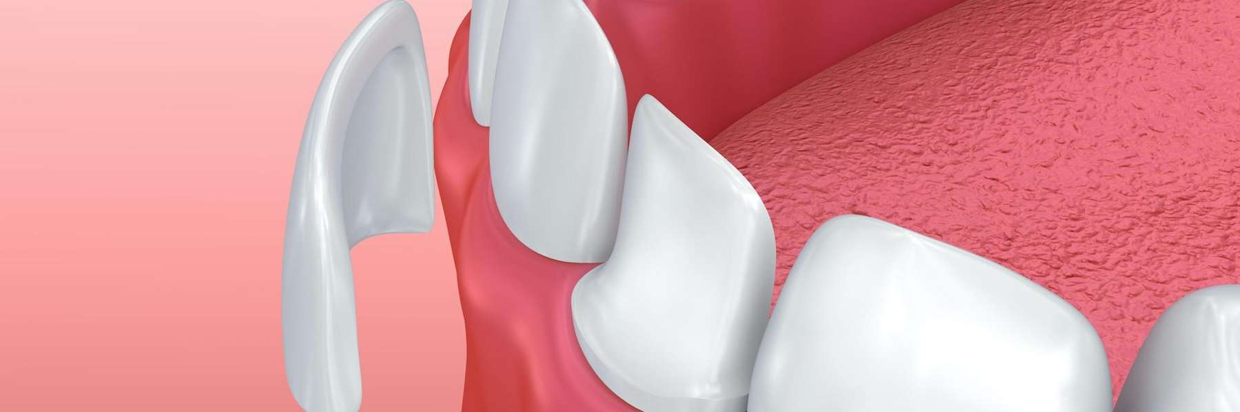 porcelain veneer illustration