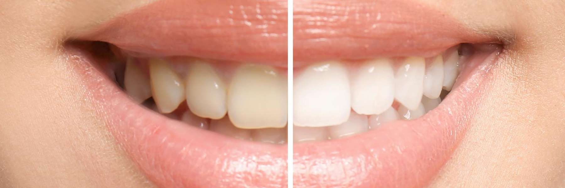 before and after teeth whitening in Vienna Family Dental