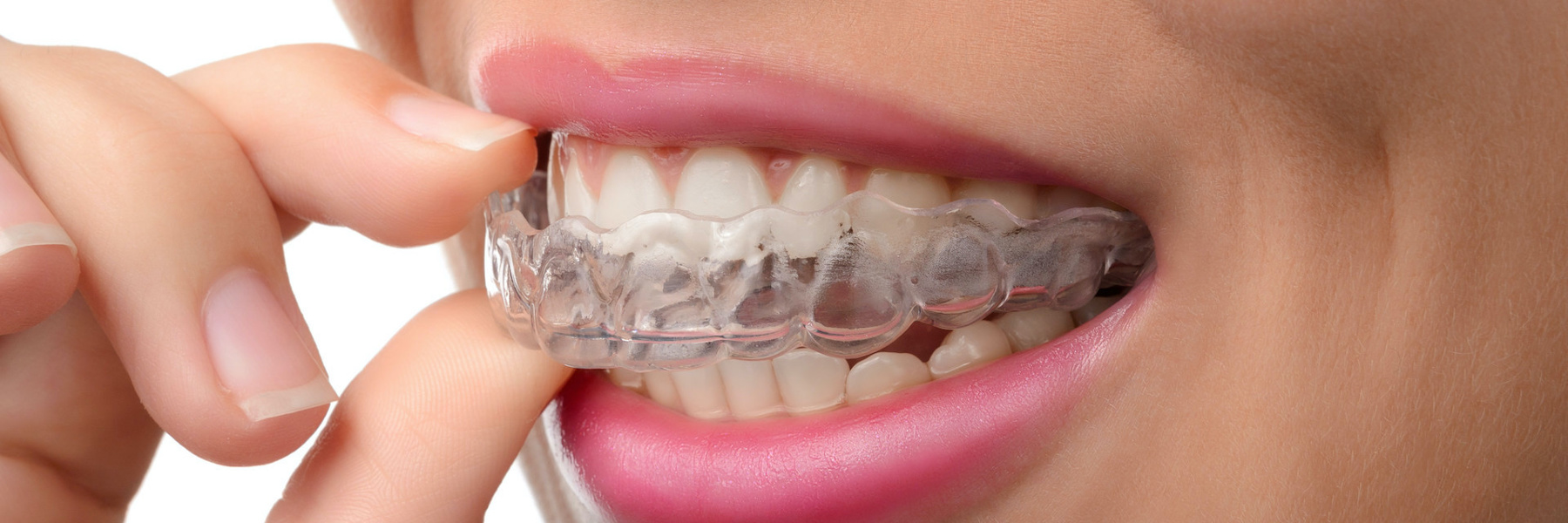 Patient inserting clear Invisalign aligners for smile makeover Vienna