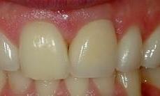 After Dental Implants in Vienna Family Dental