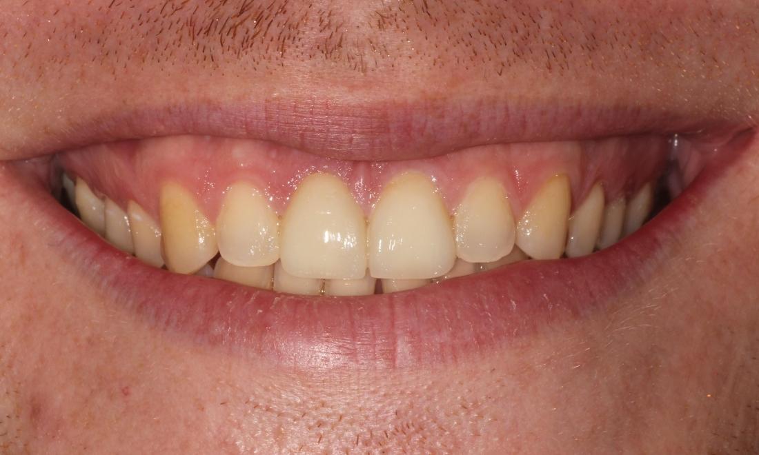 After Gum Repositioning and Veneers