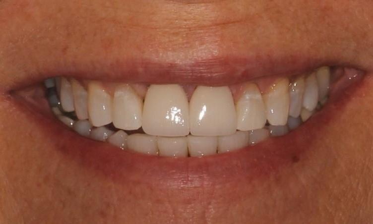 After Implant Crown in Vienna Family Dental