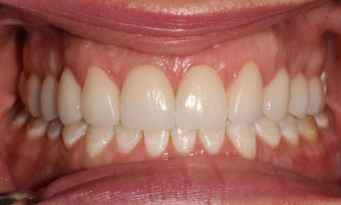after crown lengthening and veneers