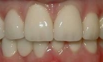 After Porcelain Crowns in Vienna Family Dental