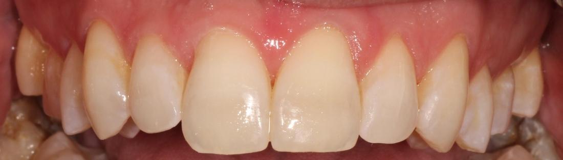 After white spots/brown spots treatment