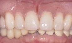 After Dentures & Partial Dentures in Vienna, VA