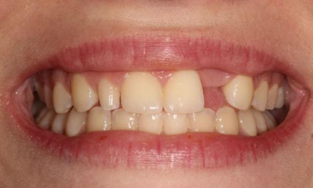 Before Bonding, and Maryland Bridge in Vienna Family Dental