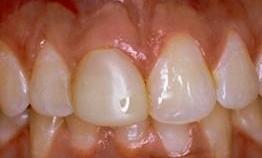 Before crown work in Vienna Family Dental