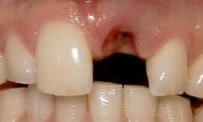 Before Dental Implants in Vienna Family Dental