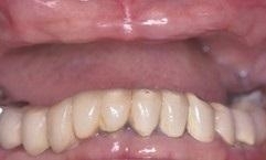 Before Dentures & Partial Dentures in Vienna, VA