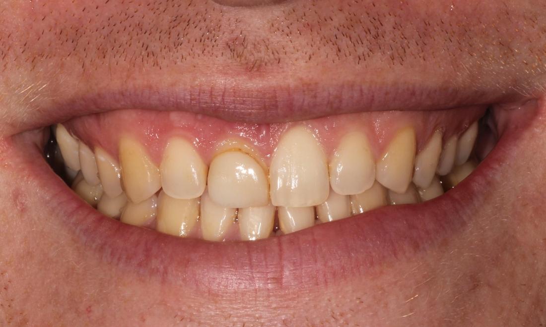 Before Gum Repositioning and Veneers