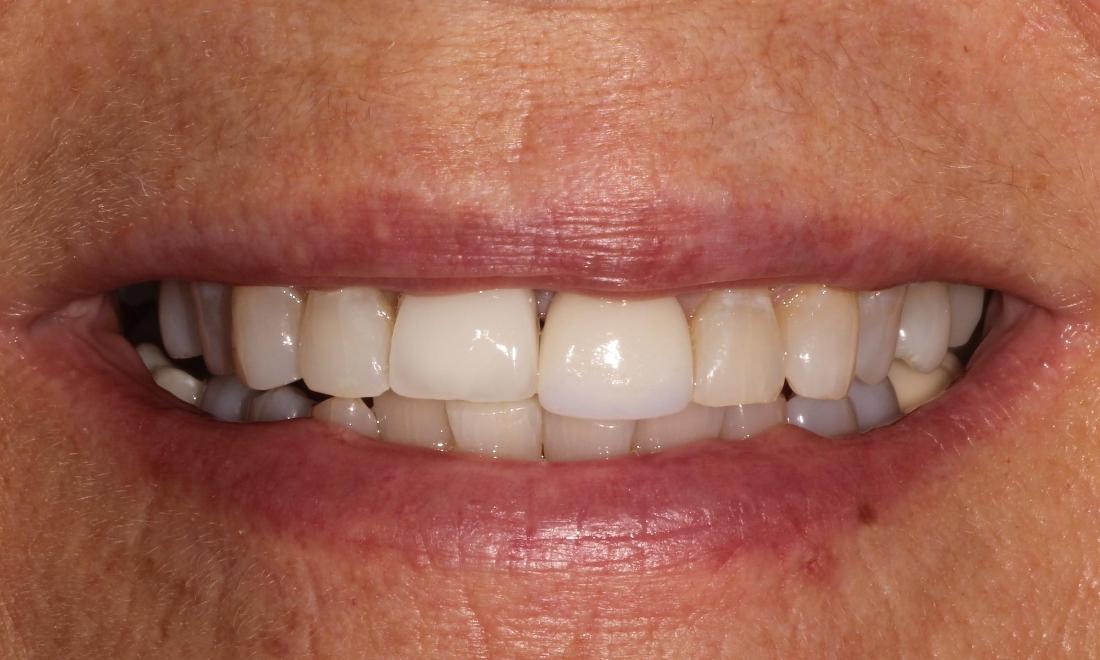 Before Implant Crown in Vienna Family Dental