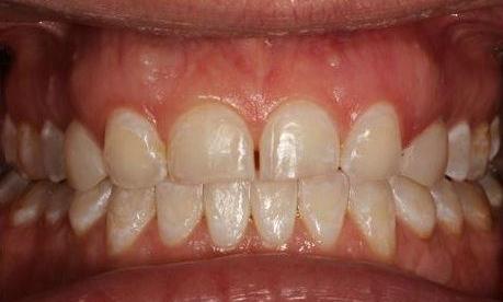 before crown lengthening and veneers