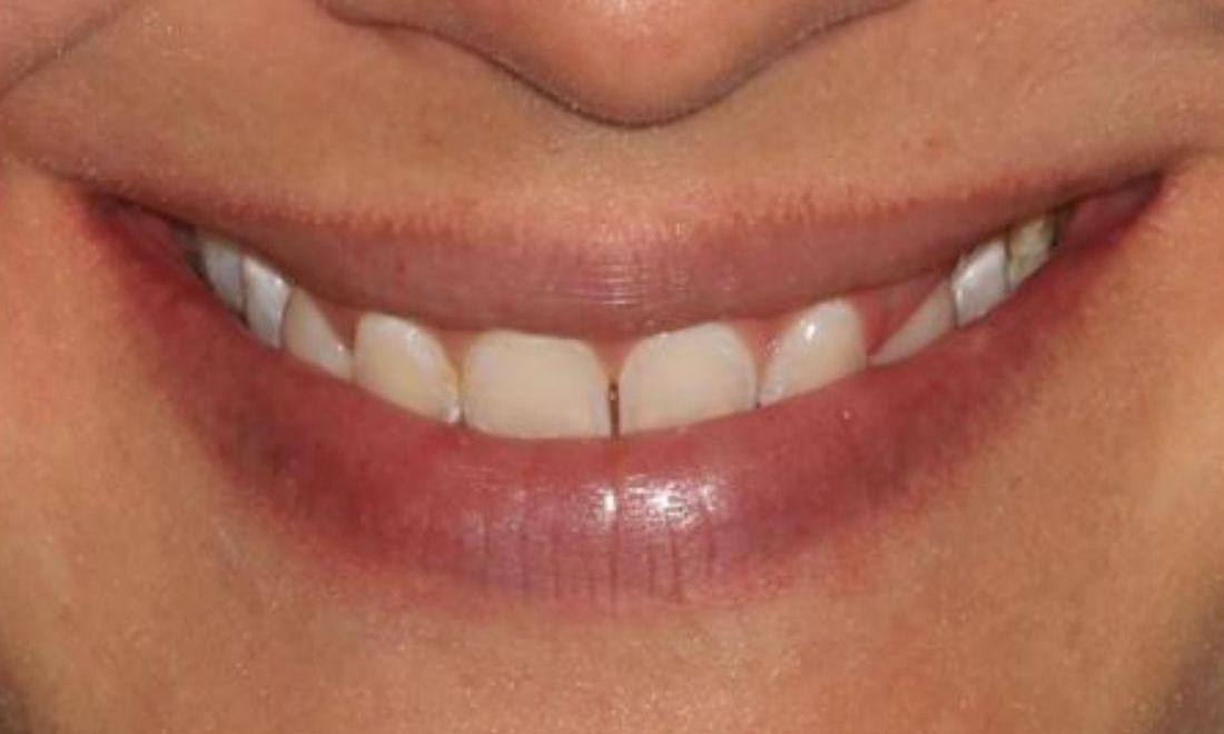 Before Invisalign, Crown Lengthening, and Veneers in Vienna Family Dental
