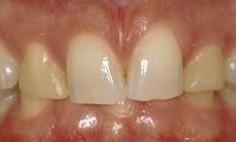 Before Porcelain Crowns in Vienna Family Dental