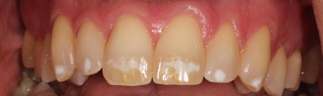 Before white spots/brown spots treatment