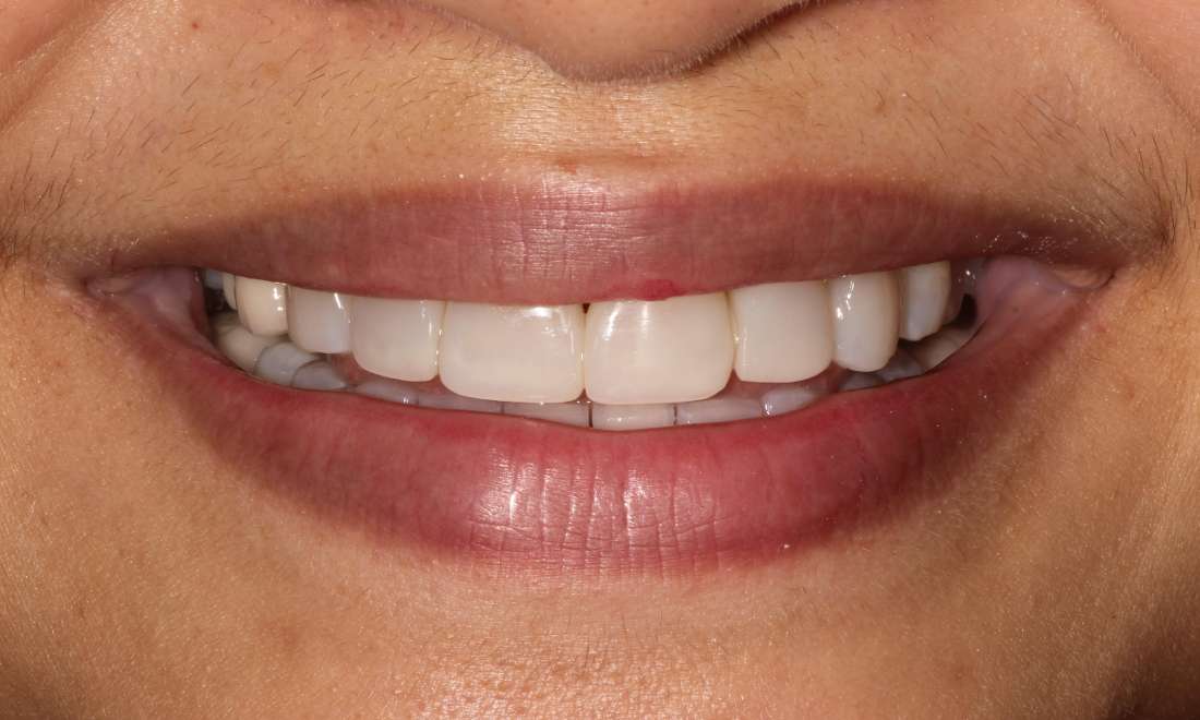 Closeup After Composite Veneers