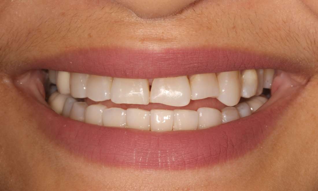 Closeup Before Composite Veneers