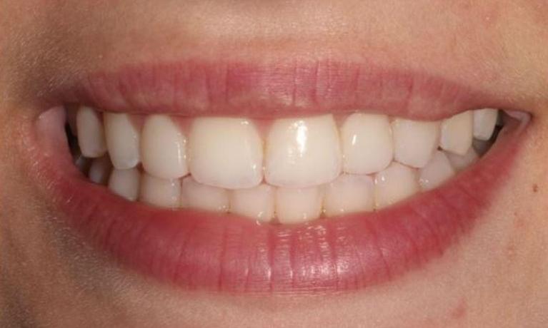 Whitening-Bonding-Maryland-Bridge-After-Image