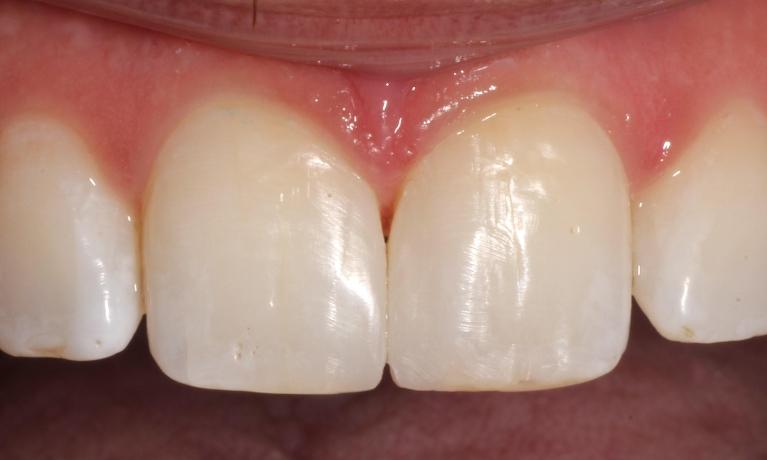 after repairing chipped or fractured teeth using composite filling