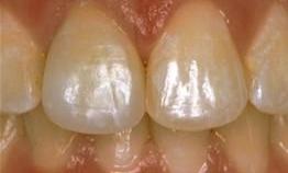 After crown work in Vienna Family Dental