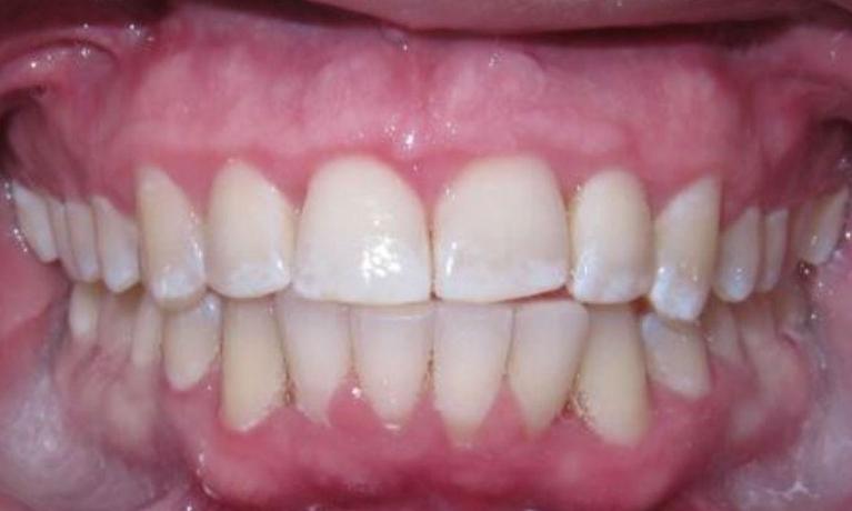 Deep-Cleaning-and-Invisalign-After-Image