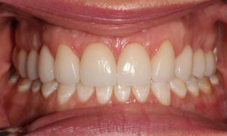 after crown lengthening and veneers