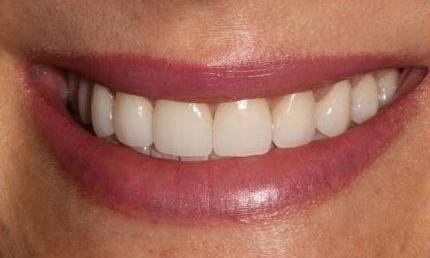 Invisalign-Crown-Lengthening-and-Veneers-After-Image