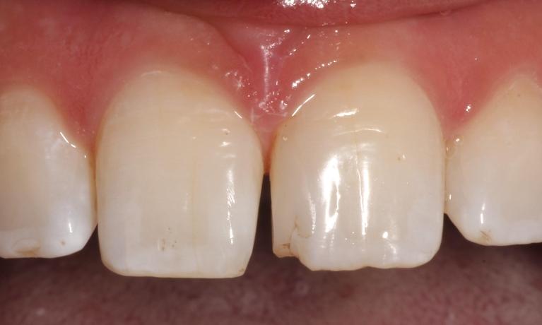 before repairing chipped or fractured teeth using composite filling