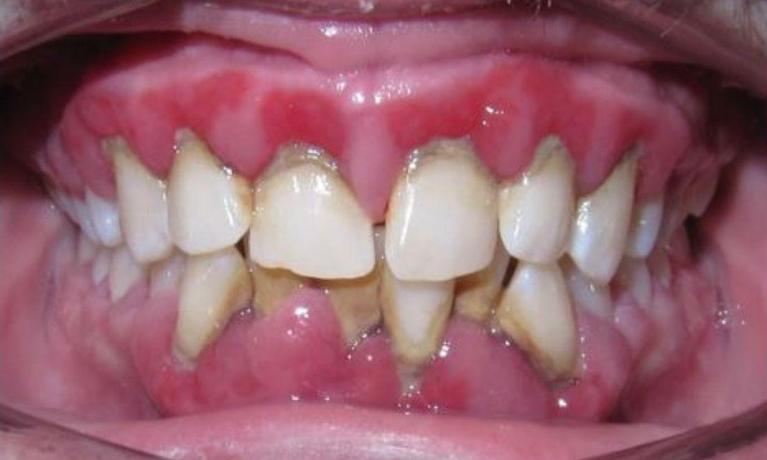 Deep-Cleaning-and-Invisalign-Before-Image
