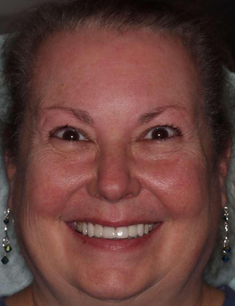 Smile-Makeover-Using-a-Digital-Smile-Design-Process-After-Image