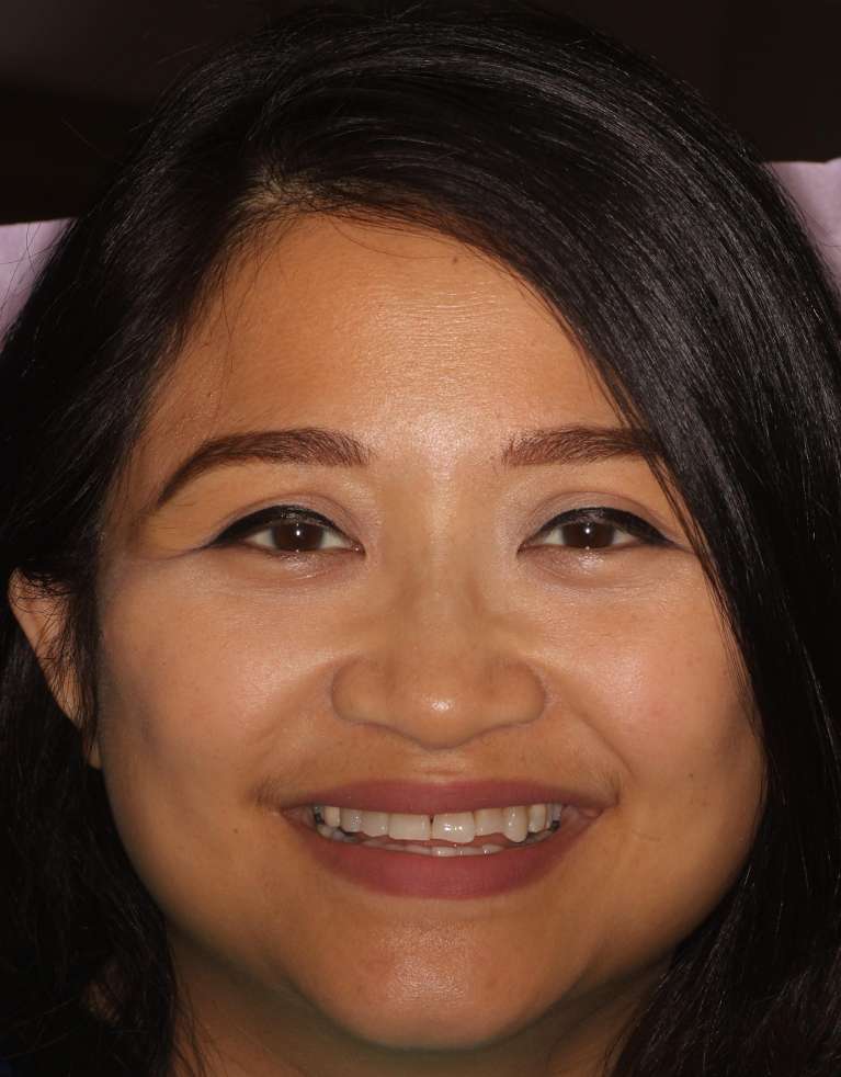 Composite-Veneers-Before-Image