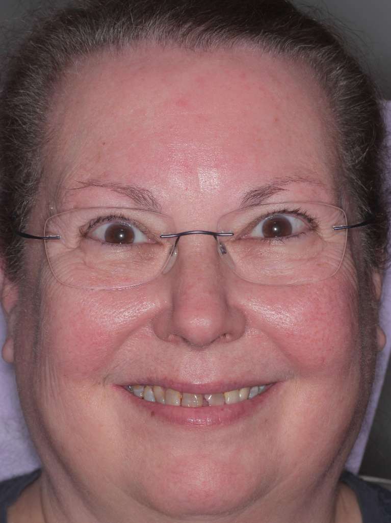 Smile-Makeover-Using-a-Digital-Smile-Design-Process-Before-Image